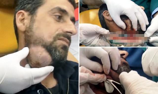 Το Σαγόνι του είχε Πρηστεί σαν Μπαλόνι. Μόλις ο Χειρούργος είδε ΤΙ βγήκε από μέσα, Πάγωσε!