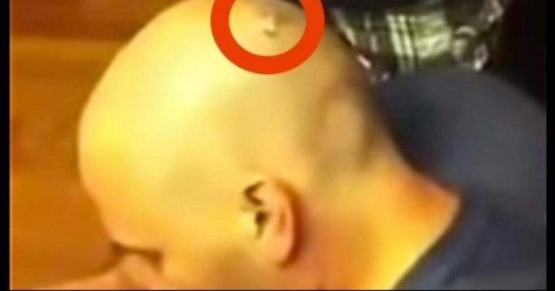 Αισθανόταν Φαγούρα στο Κεφάλι του και αυτό που το προκαλούσε ήταν ένα παράσιτο