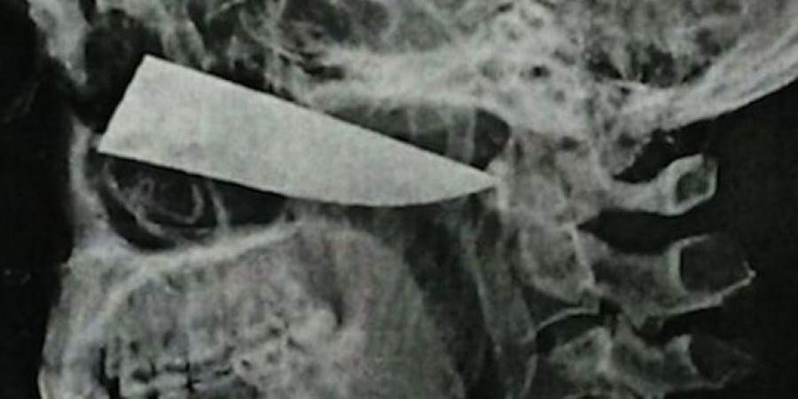 Έζησε με ένα μαχαίρι καρφωμένο στο πρόσωπο επί τέσσερις μέρες
