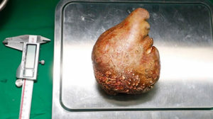 Αφαιρέθηκε η μεγαλύτερη πέτρα στα νεφρά – Κατέρριψε το ρεκόρ Γκίνες